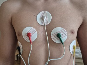Umístění barevných elektrod EKG Holteru na hrudníku